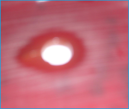 Inhibitory zone of gentamycin on S. aureus strain.
