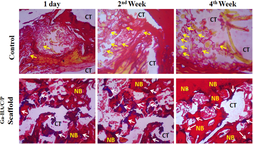 H&E staining of experimented tissue without implantation (Control) and after implantation with Ga-HA/C/P scaffold on day 1, week 2 and week 4. Yellow arrow- Osteoblasts; White arrow- Matured bone cells; CT- Connective tissues; NB- New bone. Fig. 8 portrays the histological segments of H&E stained bone tissues. In controls, the osteoclasts survival in the bone medium are gotten as violet stained domain as designated by yellow shafts while the white circumstantial specified the occurrence of connected tissues. After 24 hr, 2nd week and 4th week of implantation, there was no indication for the development of new bone cells in the normal group.