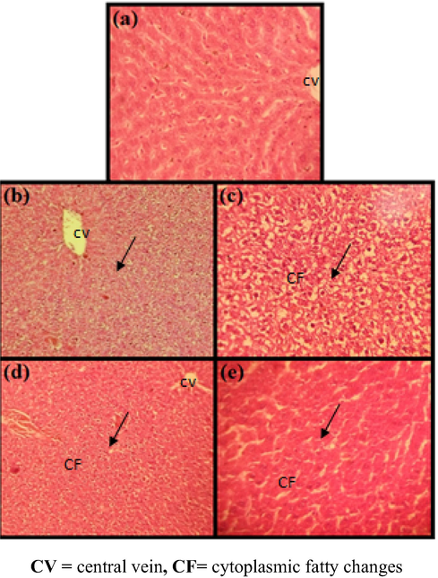 Liver images of rats receiveda daily oral low dose of PtNPs (5 µg/g) for 3 weeks and CCl4induced on 7th day. (a) No lesions were observed in hepatocytes, (b, c) and Cytoplasmic fatty vaculation of the interlobular hepatocytes, (d, e) Semi normal H & E (×100).