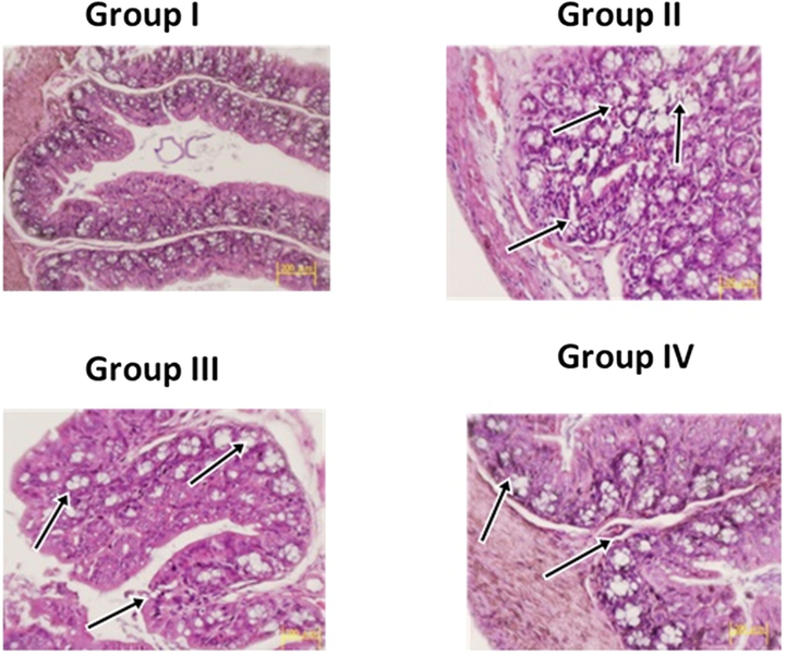 Histopathology of Colon mucosa on control and experimental rats. Histological results of colon mucosaof control and experimental rats. (a and d) control and DMH along with hesperidin (10 mg/kg b.w) rats showing normal & moderate colon mucosa design. DMH (1,2-Dimethylhydrazine) alone rat colonic (group II) displays viewing defeat of epithelial veracity, with expand lumen, important lymphoid summative, seditious cell infiltrate in the mucosal layers. The colonic mucosa of DMH + hesperidin 5 mg/kg body weight (group III) depicts near normal colonic mucosal structural pattern. Histological alterations were pointed out by the arrow marks.