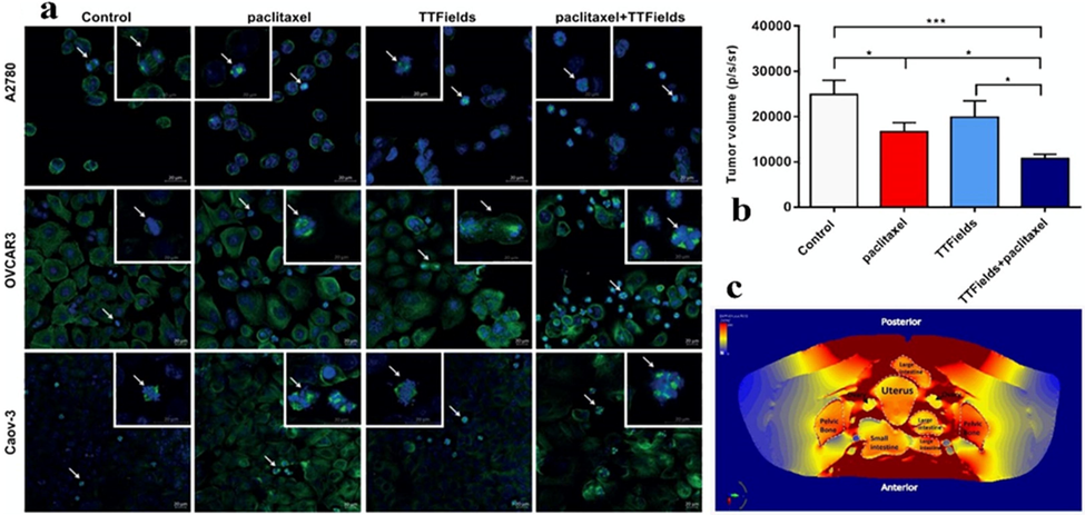 (a) Mitotic Figures shown using confocal fluorescence microscopy in A2780 cells for 8 hr, OVCAR-3 cells for 16 hr, and Caov-3 cells for 72 hr). The small micrographs represent the cell phases of metaphase and late anaphase. Green, tubulin, blue, DAPI-stained DNA. (b) The bioluminescent signal from tumors was used to predict tumor growth. (c) TTField intensity focused on the organ directly affected by the treatment (Voloshin, 2016). Figures reprinted with Creative Commons Attribution 2.0 (CC-BY-0.2) License from Ref. (Voloshin, 2016).