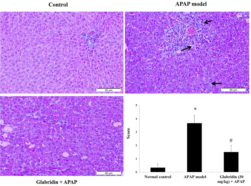 Effect of glabridin on histopathological changes in APAP-induced rats. Injury scores were given by a blinded pathologist on a scale of 0–4; 0 = no changes, 1 = mild changes, 2 = moderate pathological changes, 3 = bad injury and pathological changes, 4 = severe injury and inflammation. Black arrows indicate damaged hepatocytes due to necrosis/apoptosis, infiltration of inflammatory cells, and dilated sinusoids. Data were shown as mean ± SD (n = 6). Data were shown as mean ± SD (n = 6). ‘*’ represents statistical difference (p < 0.05) from normal group I, whereas ‘#’ represents statistical difference (p < 0.05) from APAP-induced group II. Liver tissues were stained with H&E for pathological verification and viewed at 100× magnification.