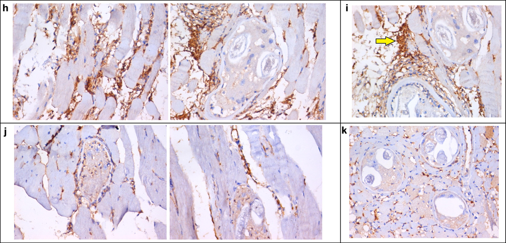 (a) A section in skeletal muscle of -ve control group showing negative expression of CD34, except in a few capillaries (arrows) (IHC for CD34, DAB, X400). (b) A section in skeletal muscle of + ve control group (G-I) showing dense expression of CD34 in skeletal muscles around Trichina capsules (arrows) (IHC for CD34, DAB, X200 (left), X400 (right)). (c) A section in skeletal muscle of Group II, showing dense expression of CD34 in skeletal muscles around Trichina capsules (arrows) (IHC for CD34, DAB, X400). (d) A section in skeletal muscle of G-IIIb, showing moderate expression of CD34 in skeletal muscles around Trichina capsules (arrows) (IHC for CD34, DAB, X400). (e) A section in skeletal muscle of G-IIIc, showing moderate expression of CD34 in skeletal muscles around Trichina capsules (arrow) (IHC for CD34, DAB, X400). (f) A section in skeletal muscle of G-IVb, showing mild expression of CD34 in skeletal muscle capillaries and around Trichina capsules (arrow) (IHC for CD34, DAB, X400). (g) A section in skeletal muscle of G-IVc showing mild expression of CD34 in skeletal muscles around degenerated Trichina capsules (arrow) (IHC for CD34, DAB, X400). (h) A section in skeletal muscle of G-Vb, showing dense expression of CD34 in skeletal muscle capillaries and around Trichina capsules (arrow) (IHC for CD34, DAB, X400). (i) A section in skeletal muscle of G-Vc, showing moderate expression of CD34 in skeletal muscles around Trichina capsules (arrow) (IHC for CD34, DAB, X400). (j) A section in skeletal muscle of G-VIb, showing very mild expression of CD34 in skeletal muscle capillaries and around degenerated Trichina capsules (arrow) (IHC for CD34, DAB, X400). (k) A section in skeletal muscle of G-Vic, showing scattered mild expression of CD34 in skeletal muscle capillaries around small degenerated Trichina capsules (arrow) (IHC for CD34, DAB, X400).