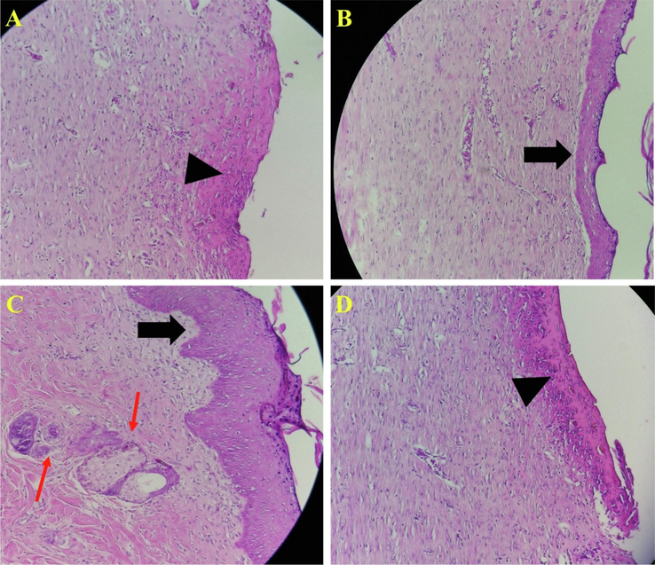 Histopathology evaluation of wounds stained with Hematoxylin and eosin (H&E) staining. (A) negative control group (without treatment), (B) wound treated with PCL/CMC/CoHA 5%, (C) wound treated with PCL/CMC/CoHA 10%, and (D) wound treated with PCL/CMC/CoHA 15%. The treatment using PCL/CMC/CoHA 15% resulted in healing outcomes like the negative control group, unformed epidermal layer, crusty scab coverage and PMNs infiltration.