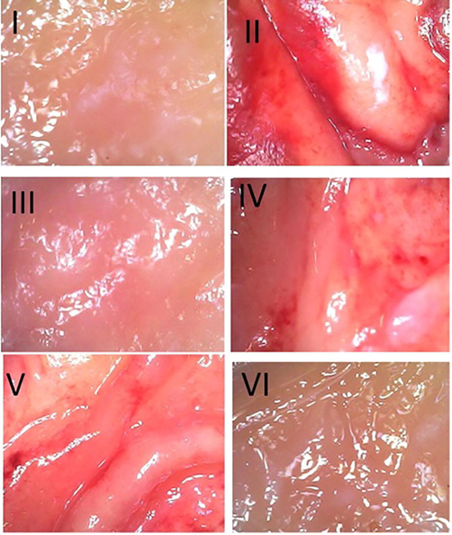 Examination of hemorrhagic lesions macroscopically on the glandular part of the rat stomach. I, II, III, IV, V and VI are representative photos from groups 1, 2, 3, 4, 5 and 6 respectively. Photo II showed the most severe hemorrhagic lesions on the glandular part of the stomach obtained from Group 2.