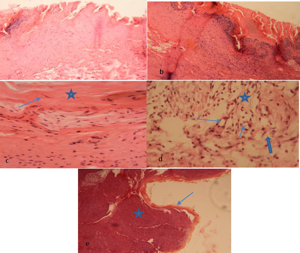 (a) Control group showing edematous reaction indicated by Eosinophillic homogenous masses admixed with mononuclear cellular infiltrate, (b) partial formation of surface skin layer epidermis with less deposition of keratinized tissue seen, (c) fibrocytes are seen (Blue arrow) admixed collagen fibers (star) arranged underneath epidermis layer. Some inflammatory cells masses are also seen, (d) granulation mass is seen underneath epithelium showing formation of thin-walled capillaries (Angiogenesis) indicated by blue stars in lumen. Infiltration of mononuclear cells especially neutrophils indicated by star representing host inflammatory response. Mature connective tissue cells are deposited in the form of fibrocytes and collagen fibers (Thick blue arrow) evidence of healing (Proliferation Phase) and (e) re-epithelisation is seen (thin blue arrow shows epidermis layer) clearly indicated by thin arrow a star indicates dermal region.