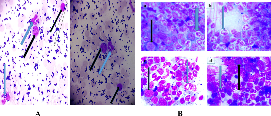 A and 1B: Photomicrograph of Leishman stained blood and bone marrow smear with the presence of blast cells (black arrow) and neutrophil (blue arrow) (MG, X100). The blast cells were myeloblast identified by the presence of fine chromatin, large nucleus, and blue cytoplasm without granules. Lymphoblast on the other hand is characterized by more coarse chromatin and small cytoplasm. Fig. 1A(a) and Fig. 1B(b): are the representative photomicrographs of blood smear of mice during induction to establish leukemia before the commencement of treatments with the plant fractions. Fig. 1B(a), 1B(b) and 1B(c) are representative of the ethylacetate, n-butanol treated and control groups with numerous differentiated cells and few myeloblast characterized by large nucleus and blue cytoplasm. Fig. 1B(d) is a representative of the leukemic untreated group with less differentiated cells and more blast cells than the representative fraction treated groups.