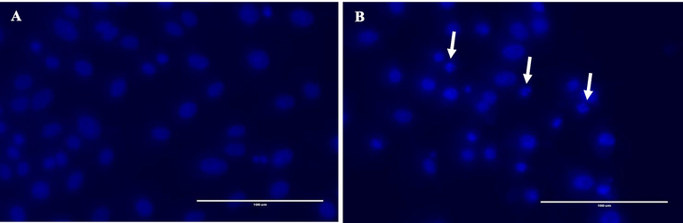 Apoptotic activity of compound 5b on MCF-7 cell (A: control and B: treated) after 24 h of treatment. White arrows represent fragmented and apoptotic nucle.