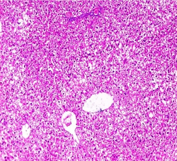 Liver sections from the experimental mice of the different study groups: Fig. 3a: section from the liver of GI, Fig. 3b: section from the liver of GII, Fig. 3c: section from the liver of GIII, Fig. 3d: section from the liver of GIV, Fig. 3e: section from the liver of GV. Fig. 3a. A section in the liver tissue of GI shows a normal hepatocyte pattern (H&E stain, X200). Fig. 3b. A section in liver tissue demonstrates moderate hepatocellular degeneration (green arrow) and focal mononuclear cellular infiltration (red arrow) (H&E stain, X400). Fig. 3c. A liver section of GIII reveals degenerated hepatocytes (green arrow) and focal mononuclear cellular infiltration (red arrow) (H&E stain, X400). Fig. 3d. A section in the liver tissue reveals mild hepatocellular degeneration (H&E stain, X200). Fig. 3e. A section in the liver tissue presents preserved hepatic lobular architecture (H&E stain, X200).