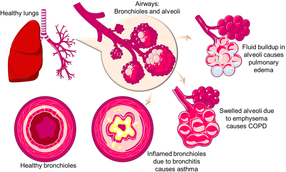 Illustration of healthy lung airways and its unhealthy states, which lead to several respiratory illnesses such as pulmonary odema, COPD, and asthma.