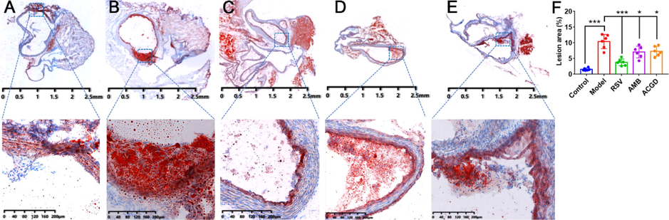 Photomicrographs of plaques at aortic valves stained with Oil red O. (A) control group; (B) model group; (C) RSV group; (D) AMB extracts group; (E) ACGD extracts group; (F) lesion area percentage of the total aorta. The scales were 2.5 mm and 200 μM (magnification, 12.5×). Data were shown as mean ± SD (n = 6). (*p < 0.05, ***p < 0.001).