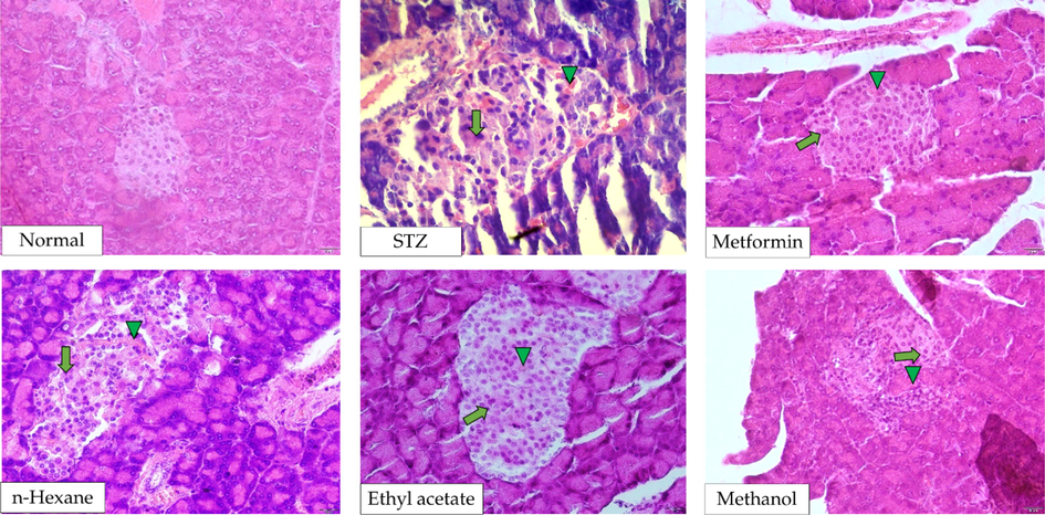 Histopathological images of pancreas after the administration of P. emblica extracts into STZ-induced diabetic rats. Necrosis and hemorrhage are indicated by arrow (↑) and triangle (▲) symbols, respectively.