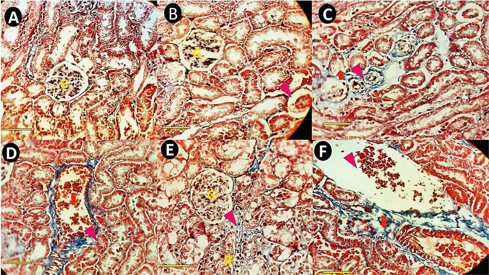 Masson's trichrome–stained sections of rat kidney cortex (×40). The scale bar represents 100 μm. (A) A representative kidney section from a normal control rat's cortex shows normal renal architecture, normal corpuscles (G), and renal tubules. (B) Renal cortex of a rat received bulk IFO (0.1 mg/kg bw) with normal glumerole. (C) Kidney section of a rat treated with bulk IFO (0.2 mg/kg bw). The arrowhead shows kidney collagen deposition, and the arrowhead shows tubular atrophy. (D) Kidney pathology images of a rat that received niosomal IFO (0.1 mg/kg bw) showing congestion (arrow) and decreasing the proximal tubule diameter (arrowhead). (E&F, kidney sections of rats treated with niosomal IFO (0.2 mg/kg bw) (E) Fibrosis (arrow) and inflammatory cells infiltration (IF) in rats treated with niosomal IFO (0.2 mg/kg bw). (F) Kidney section of a rat treated with niosomal IFO (0.2 mg/kg bw). The arrow shows extracellular matrix accumulation.