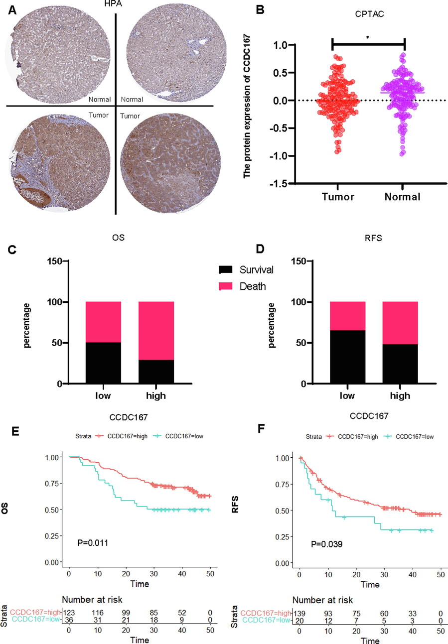 Comprehensive analysis of the expression of CCDC167 at the protein level and its relationship with the prognosis of hepatocellular carcinoma. (A) Histochemical staining of CCDC167 in normal and hepatocellular carcinoma tissues (HPA). (B) Expression analysis of CCDC167 protein in normal and hepatocellular carcinoma tissues (CPTAC),*P < 0.05. (C, D) Distribution of survival outcome and recurrence-free outcome between high and low CCDC167 protein expression groups (CPTAC). (E, F) Survival analysis and and recurrence-free survival analysis (CPTAC).