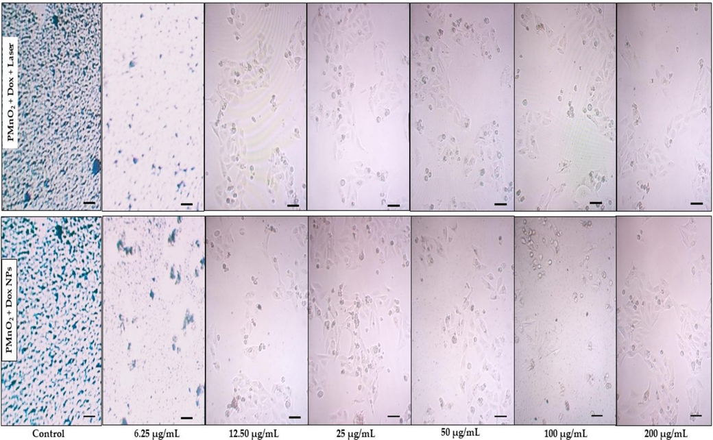 Morphological and apoptotic analysis of MCF-7 cells treated by PMnO2-Dox NPs with and without laser irradiation for 10 min. Scale bar: 100 µm for each display.