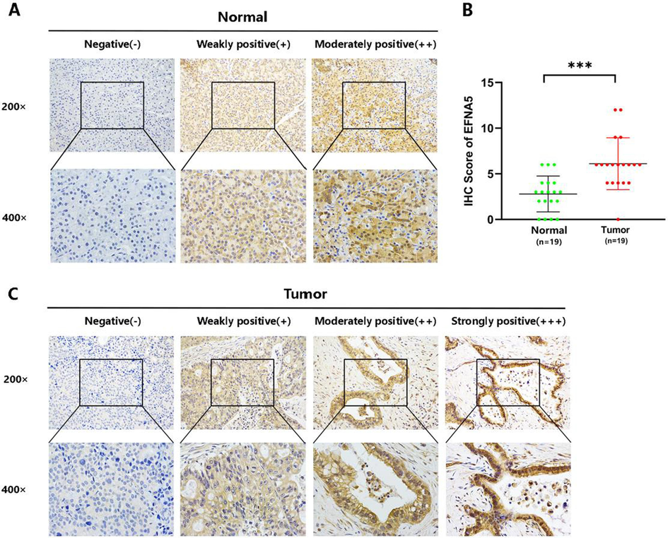 A. Immunohistochemistry (IHC) results of 19 adjacent non-cancerous tissues, showing representative images under 200x and 400x magnification. B. EFNA5 expression in pancreatic cancer tissues (n = 19) is significantly higher than in adjacent non-cancerous tissues (n = 19), with p < 0.001. Green dots represent the IHC scores of adjacent non-cancerous tissues, and red dots represent the IHC scores of cancer tissues. C. IHC results of 19 pancreatic cancer tissues, showing representative images at different staining intensities.