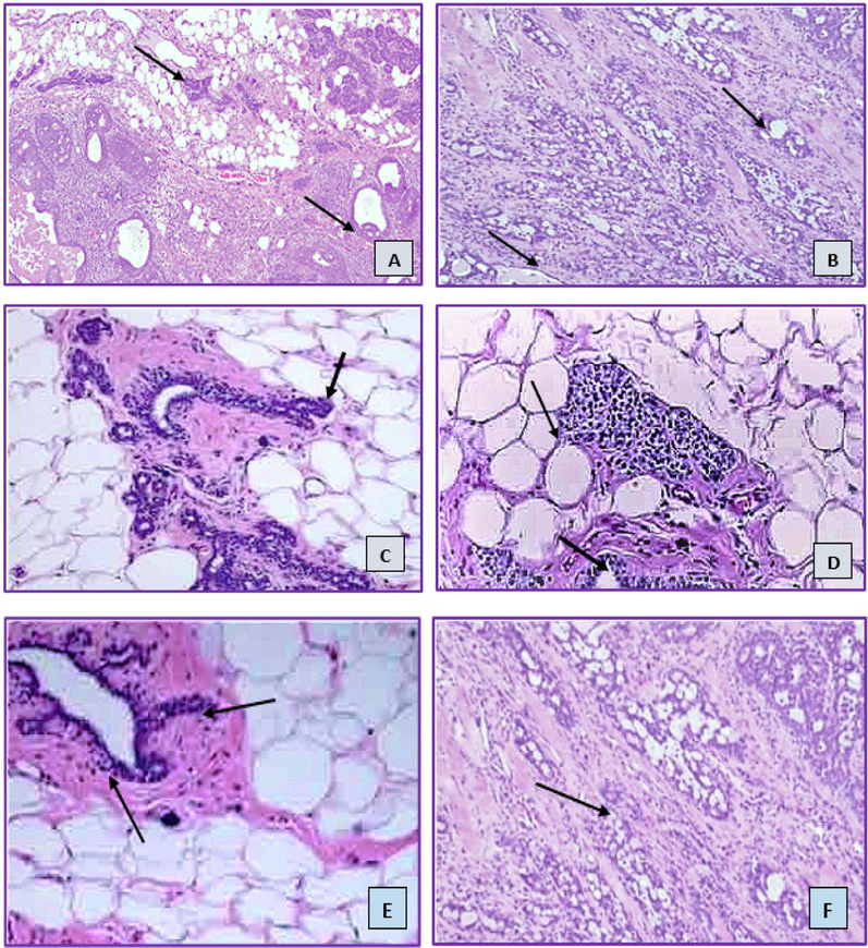 Histology images of (hematoxylin and eosin) of mammary gland tissues. (Here A: control group; B: Nanoemulsion control; C: DMBA induced untreated group; D: 2-carene treatment; E: 2-carene mediated nanoemulsion treatment and F: Essential oil treatment group).